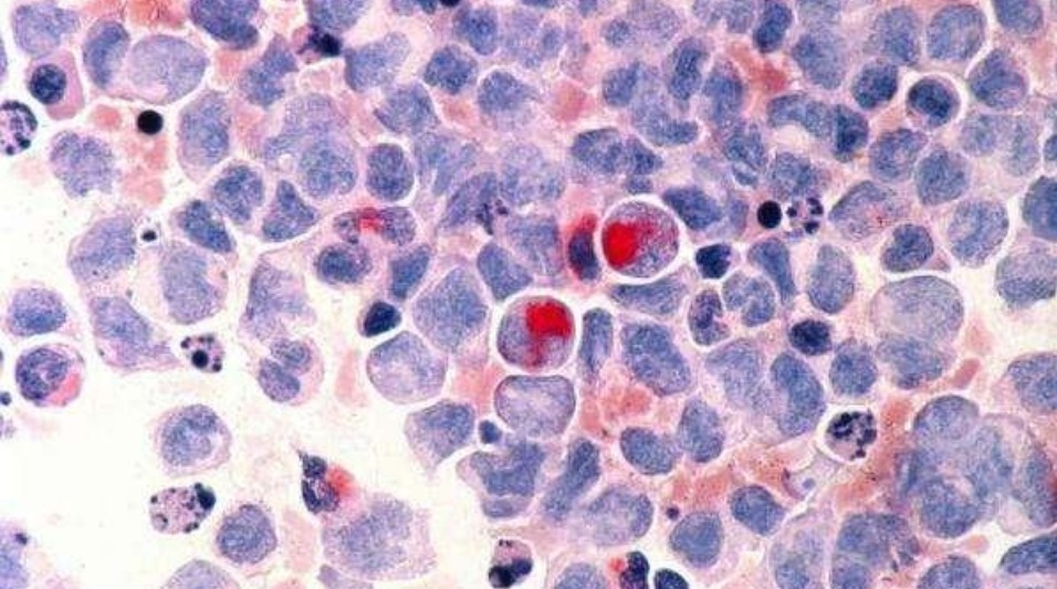 美国研发出癌症疫苗，实现100%治愈癌变细胞